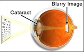 Cataract Surgery in Jalandhar Cataract Unit