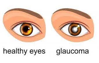 Glaucoma Management in Jalandhar Glaucoma Management