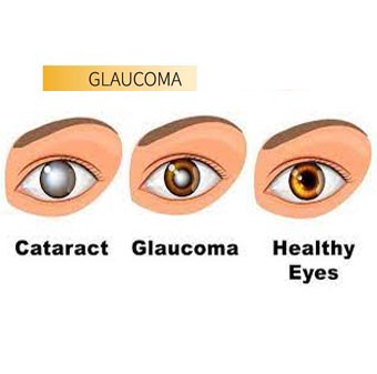 Glaucoma Management in Jalandhar Glaucoma Management