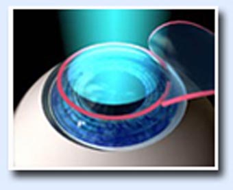 Lasik surgery in Jalandhar Lasik surgery