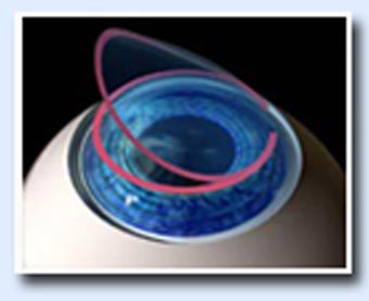Lasik surgery in Jalandhar Lasik surgery