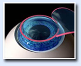 Lasik surgery in Jalandhar Lasik surgery