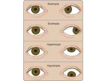 Squint and Oculoplasty in Jalandhar Squint & Oculoplasty Management