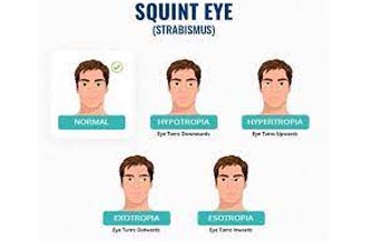 Squint and Oculoplasty in Jalandhar Squint & Oculoplasty Management