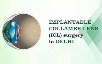 Implantable Collamer Lens Surgery in Jalandhar, Toric ICL in Jalandhar Toric ICL