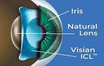 Implantable Collamer Lens Surgery in Jalandhar, Toric ICL in jalandhar Toric ICL